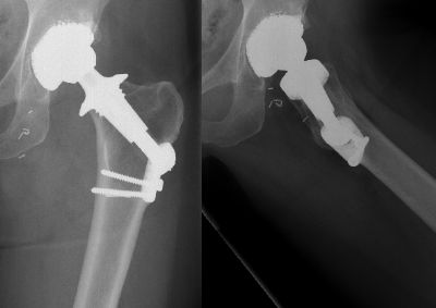 Centerpulse Druck Scheibe (Implant 30)